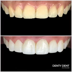 Carillas composite Denty Dent
