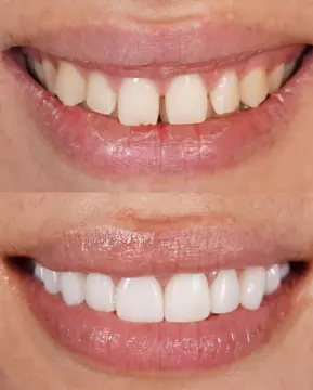 carillas composite mujer sonrisa