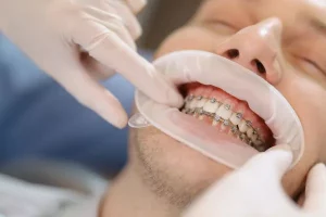Paciente microtornillos ortodoncia