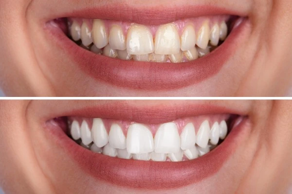 Blanqueamiento Dental antes y después