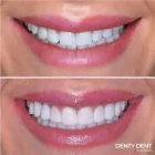 Tipos de carillas dentales