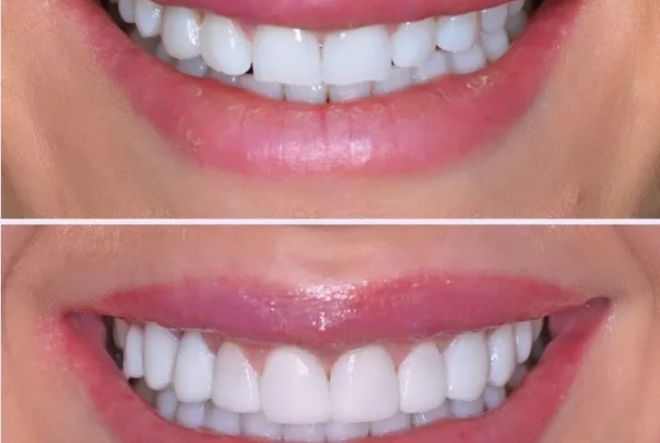 Tipos de carillas dentales
