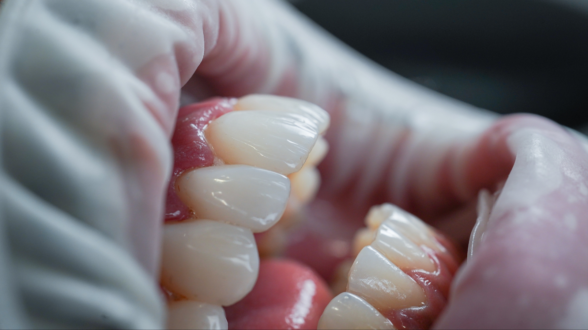 Carillas de composite en Madrid: qué son, cuánto duran y cuándo se recomiendan