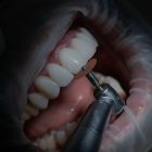 Carillas Denty Dent