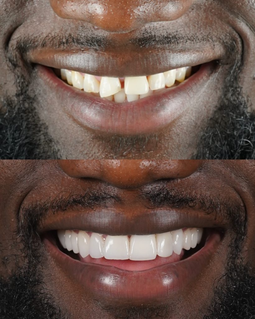 Carillas de Cerámica