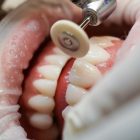 Carillas Denty Dent