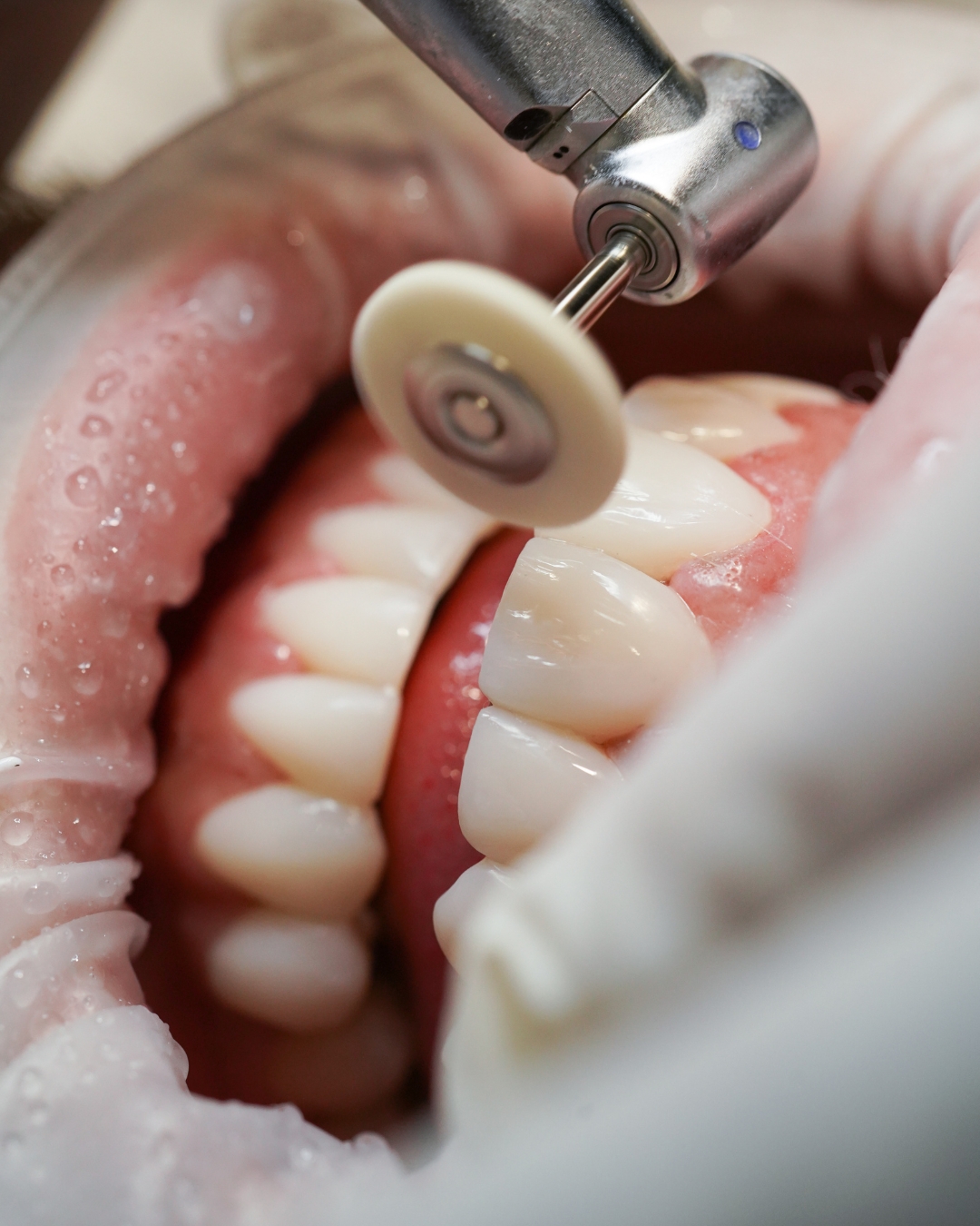 Carillas dentales: ¿composite o cerámica? Guía para elegir la mejor opción para tu sonrisa