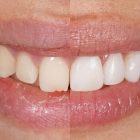 Fluorosis denta