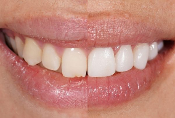 Fluorosis denta