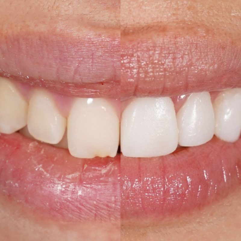 Fluorosis denta