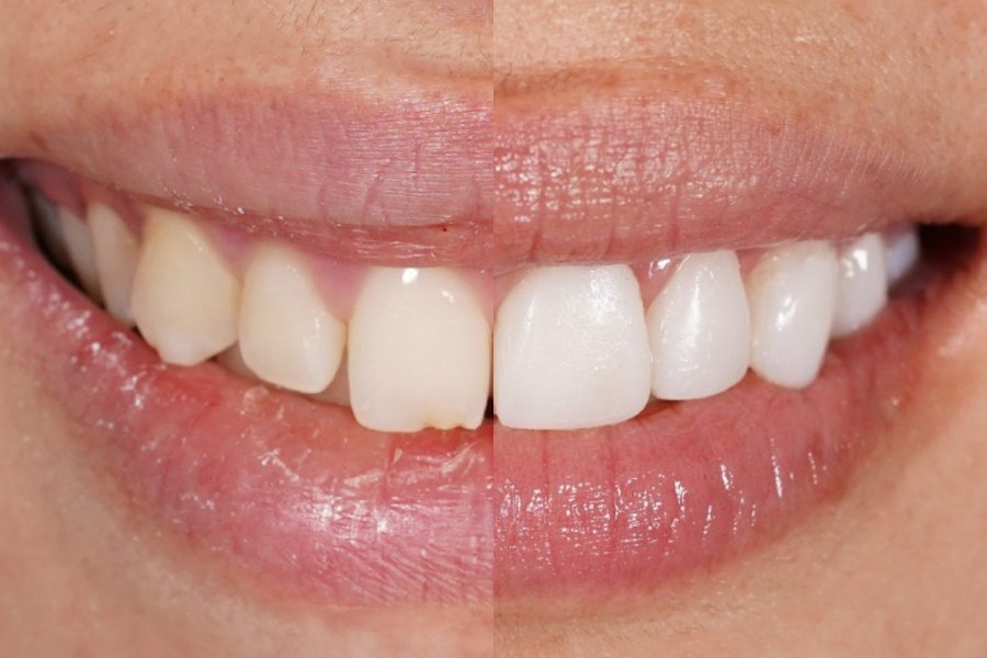 Fluorosis denta