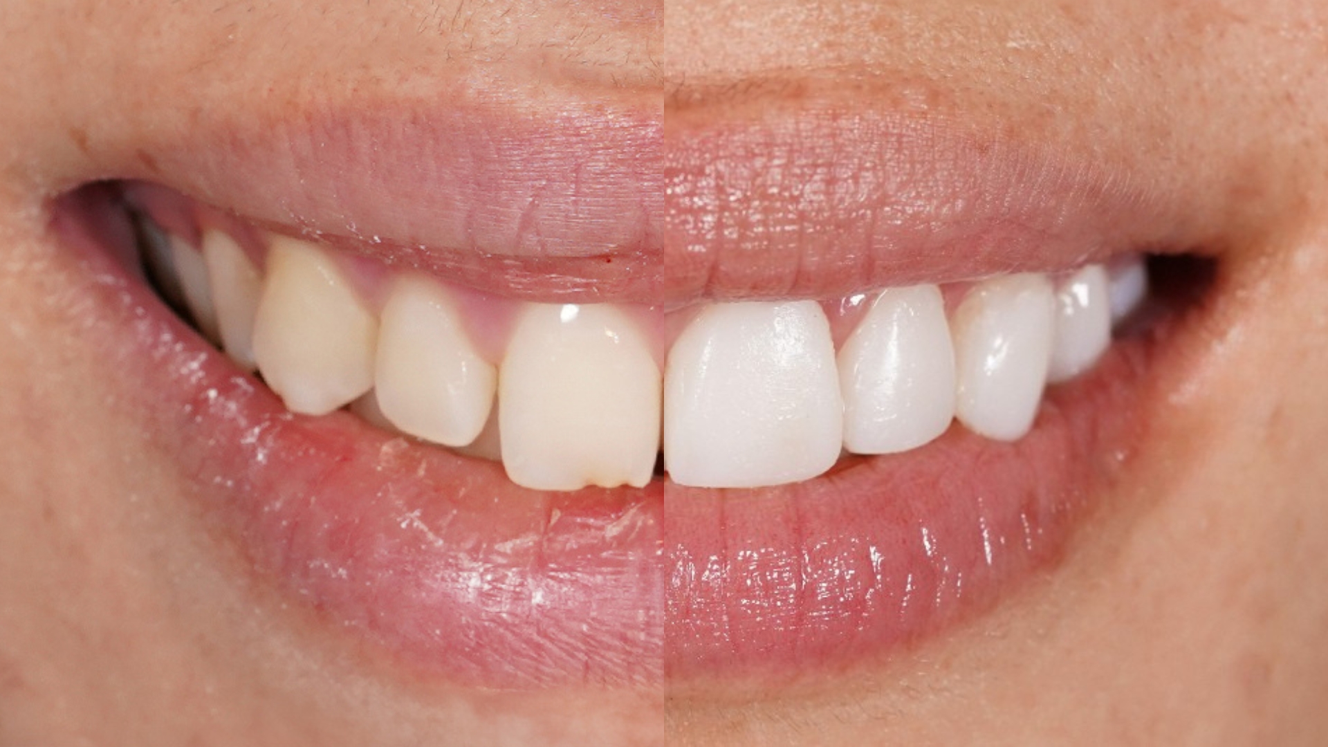 Fluorosis dental: qué es, causas y tratamiento en Madrid