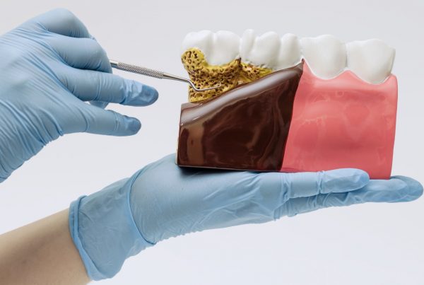 Daños del sarro en los dientes: cómo prevenirlos