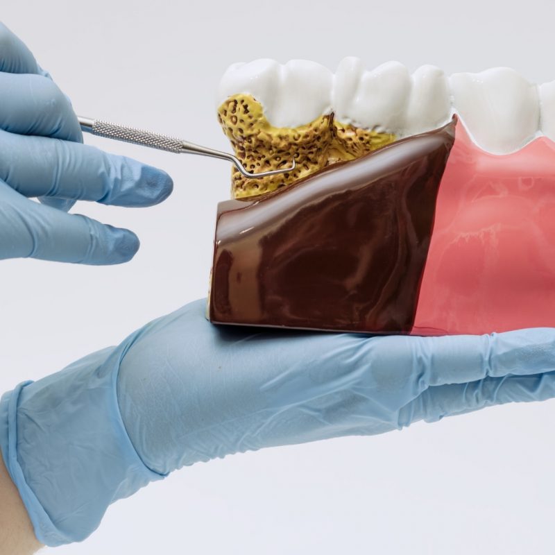 Daños del sarro en los dientes: cómo prevenirlos