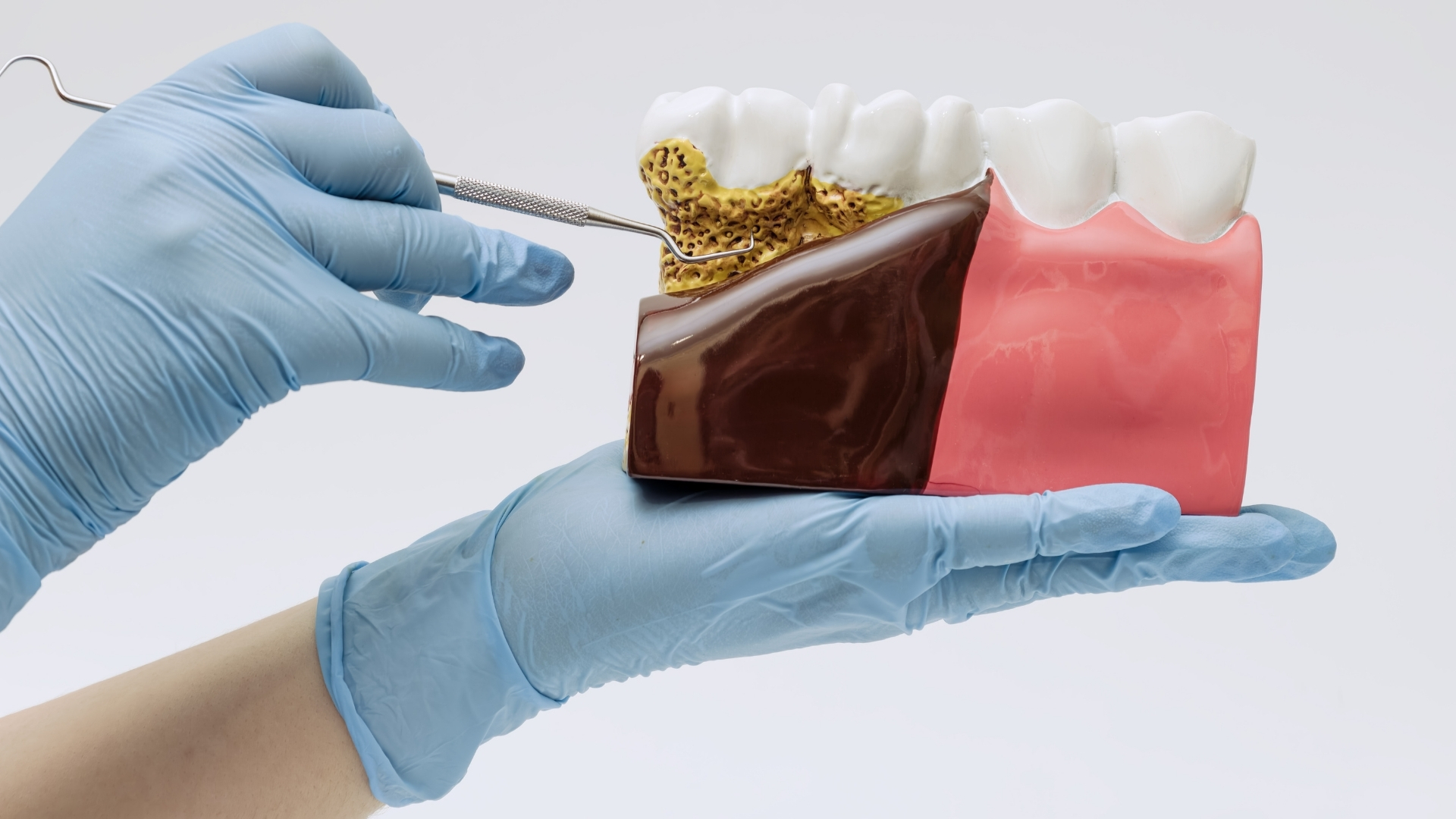 ¿Qué daños causa el sarro en los dientes y cómo eliminarlo?
